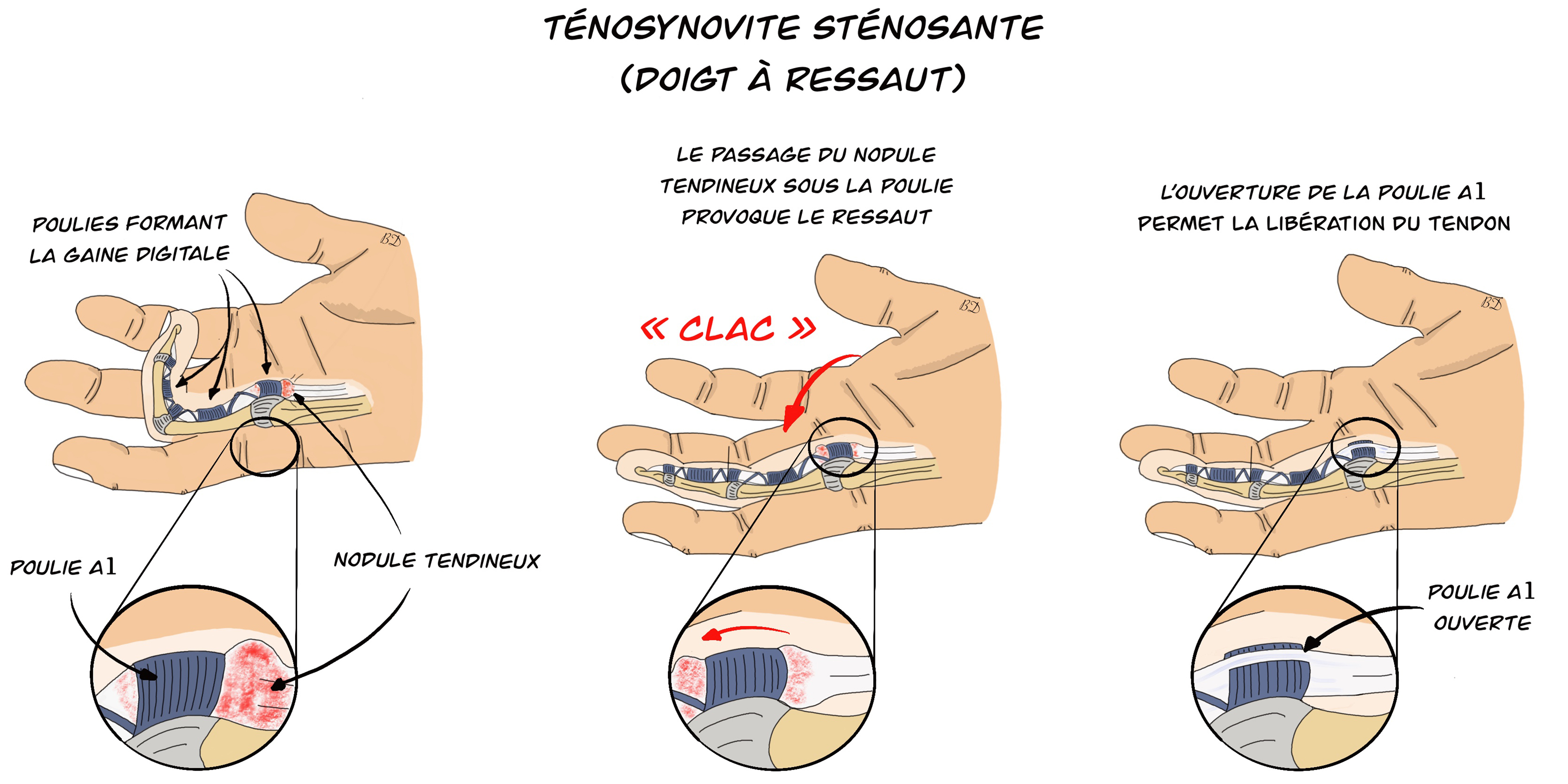 Ténosynovite sténosanté ou Doigt à ressaut