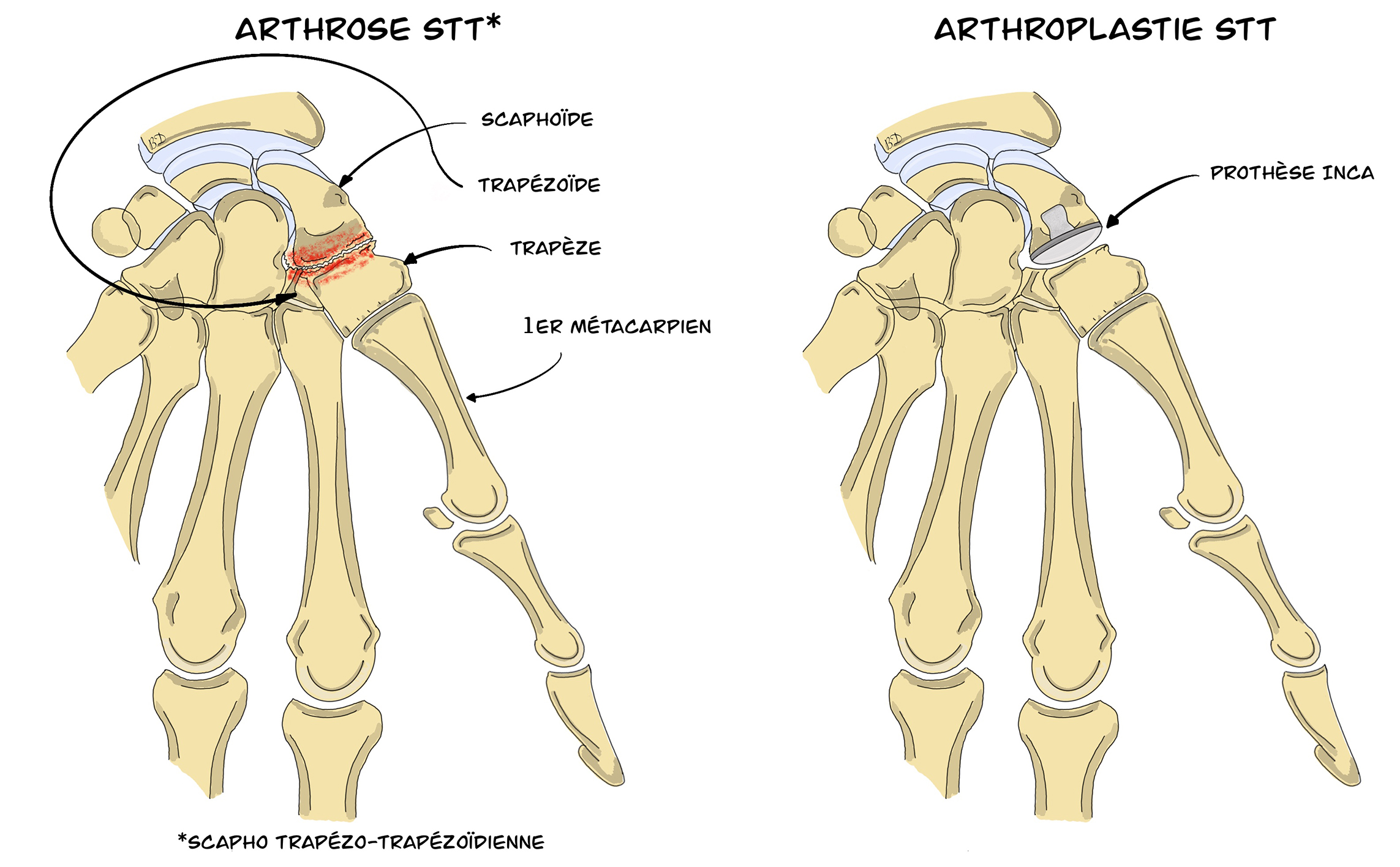 Arthroplastie Scapho-trapézo-trapézoïdienne (STT)